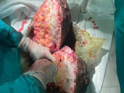 Врачи в Башкирии удалили мужчине 20-килограммовую опухоль
