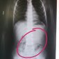 В Башкирии медики обнаружили в животе трехлетнего ребенка цепочку