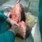Врачи в Башкирии удалили мужчине 20-килограммовую опухоль