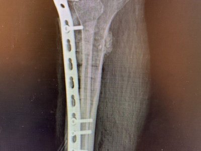 В Уфе врачи удалили опухоль из кости ноги пациента