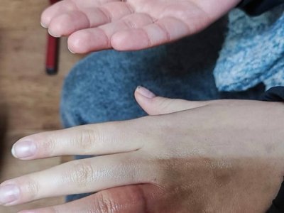 Спасатели помогли девочке из Башкирии снять кольцо с распухшего пальца