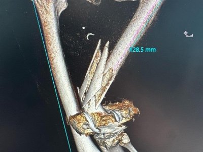 В Уфе врачи собрали обломки костей в ноге травмированной женщины