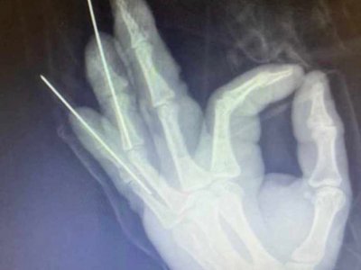 Веер из спиц: в Башкирии врачи помогли мужчине со сломанными пальцами на руке