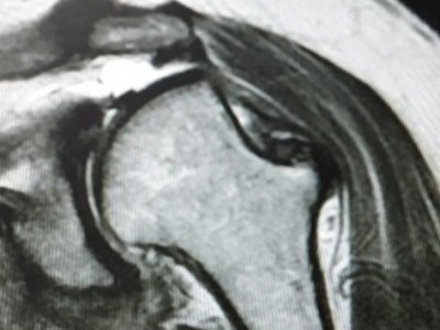 В Башкирии медики помогли женщине с повторяющимися вывихами плеча
