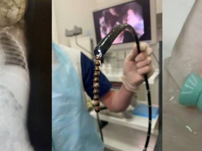 Какие проглоченные предметы вытаскивали врачи из маленьких пациентов в Башкирии