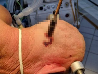 В Башкирии врачи вытащили отвертку из головы пациента