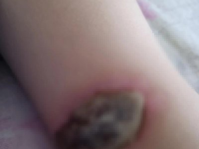 «Ожог до мяса»: в Башкирии трехлетний ребенок пострадал в детском саду