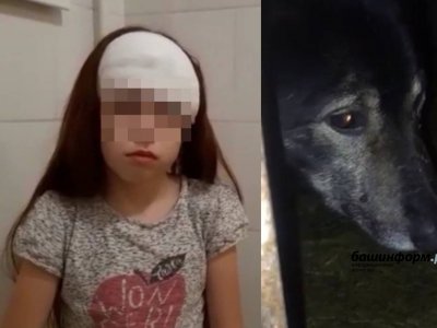 В Уфе отец пострадавшей от укусов собаки девочки сообщил, что сейчас происходит с его ребенком