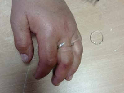 Жительница Башкирии едва не осталась без пальцев из-за сдавливающих их украшений