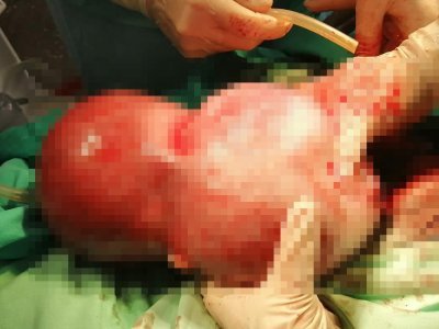 В Уфе врачи спасли новорожденного и его маму с гигантской миомой матки