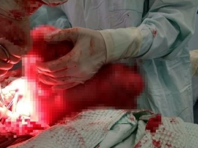 В Башкирии хирурги удалили женщине 10-килограммовую опухоль матки