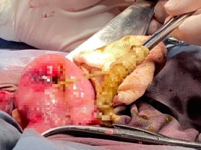В Уфе хирурги удалили у пациента огромного ленточного червя