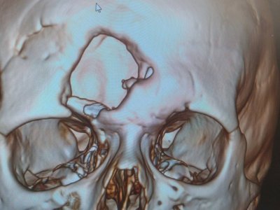 С «дырой во лбу». В Башкирии врачи установили 18-летней пациентке титановую пластину в череп
