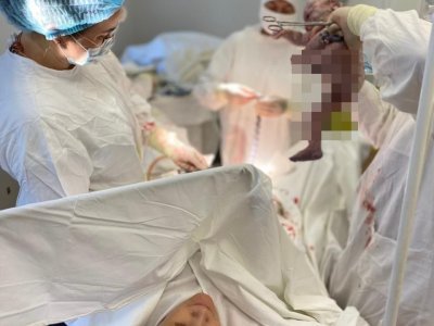 В Уфе врачи удалили у беременной пациентки гигантскую миому
