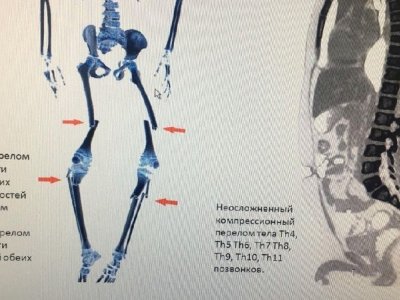 В Уфе врачи прооперировали 8-летнего мальчика со множественными переломами ног